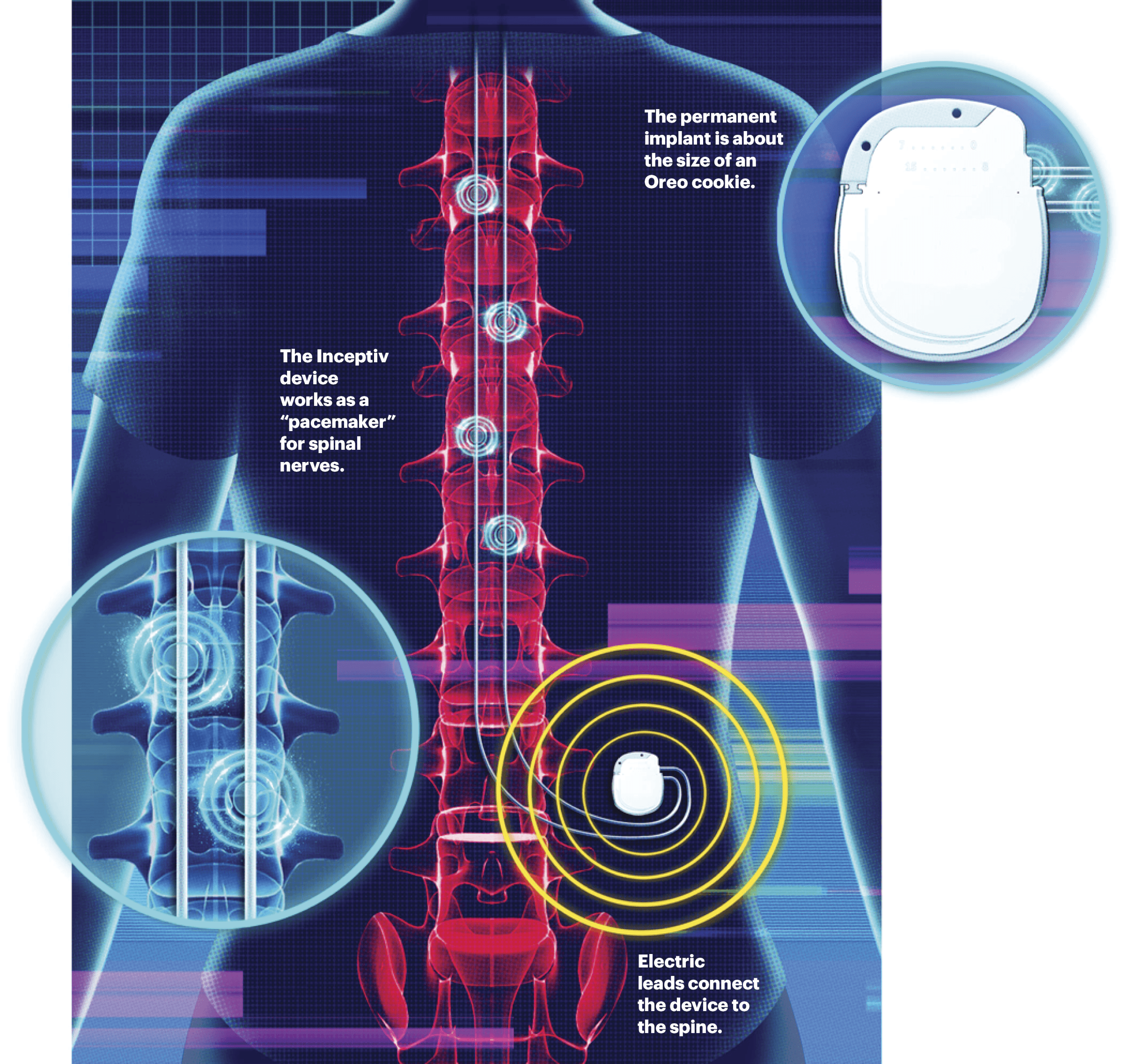 Illustration of a person’s spinal cord with several different parts highlighted 
