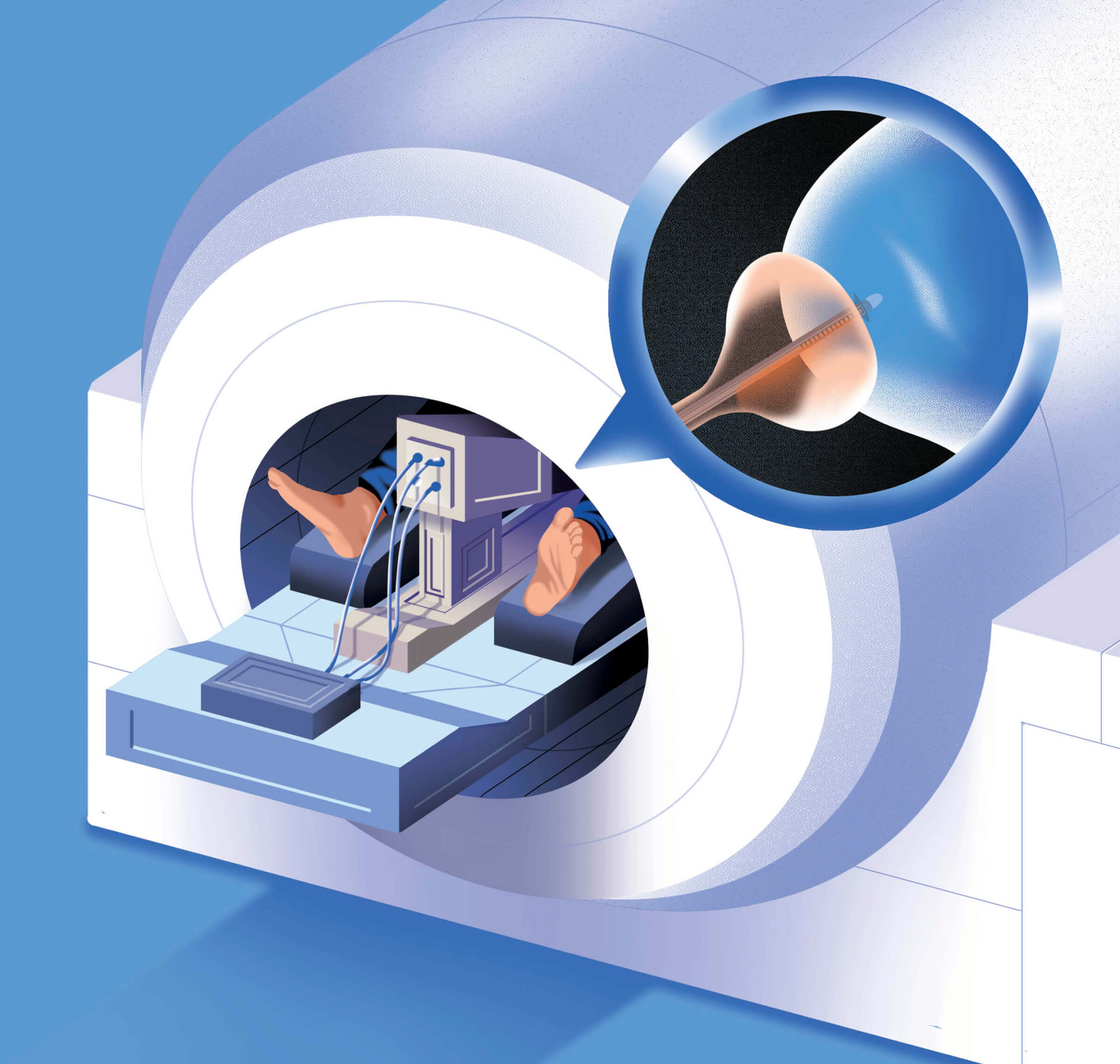 Illustration of the TULSA-Pro procedure for treating prostate cancer