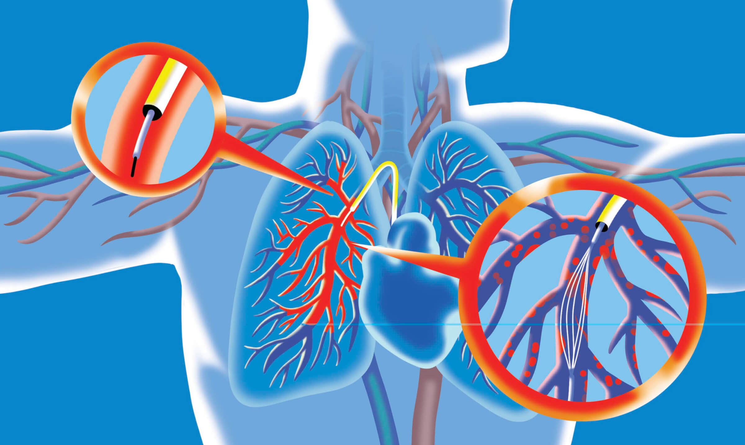 Illustration of a clot-dissolving device for human lungs