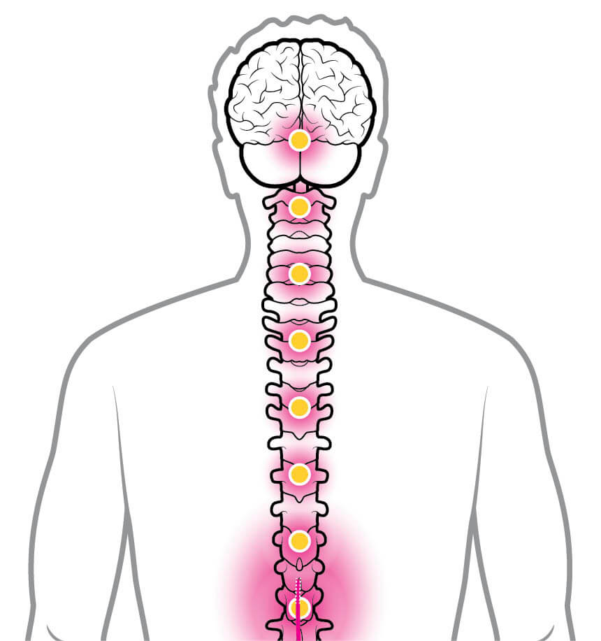 Illustration of an inflamed human spine