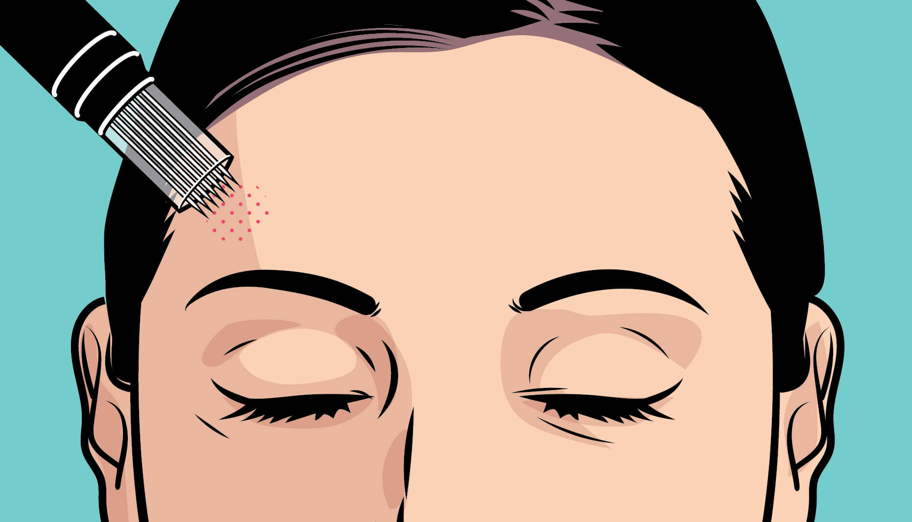 Illustration of a woman's forehead with a microneedling tool