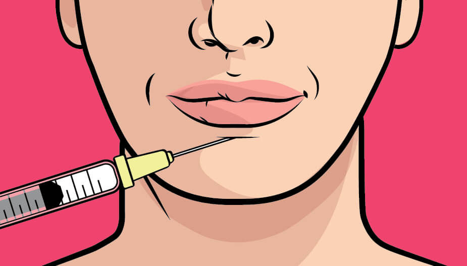 Illustration of a woman's upper chin being injected