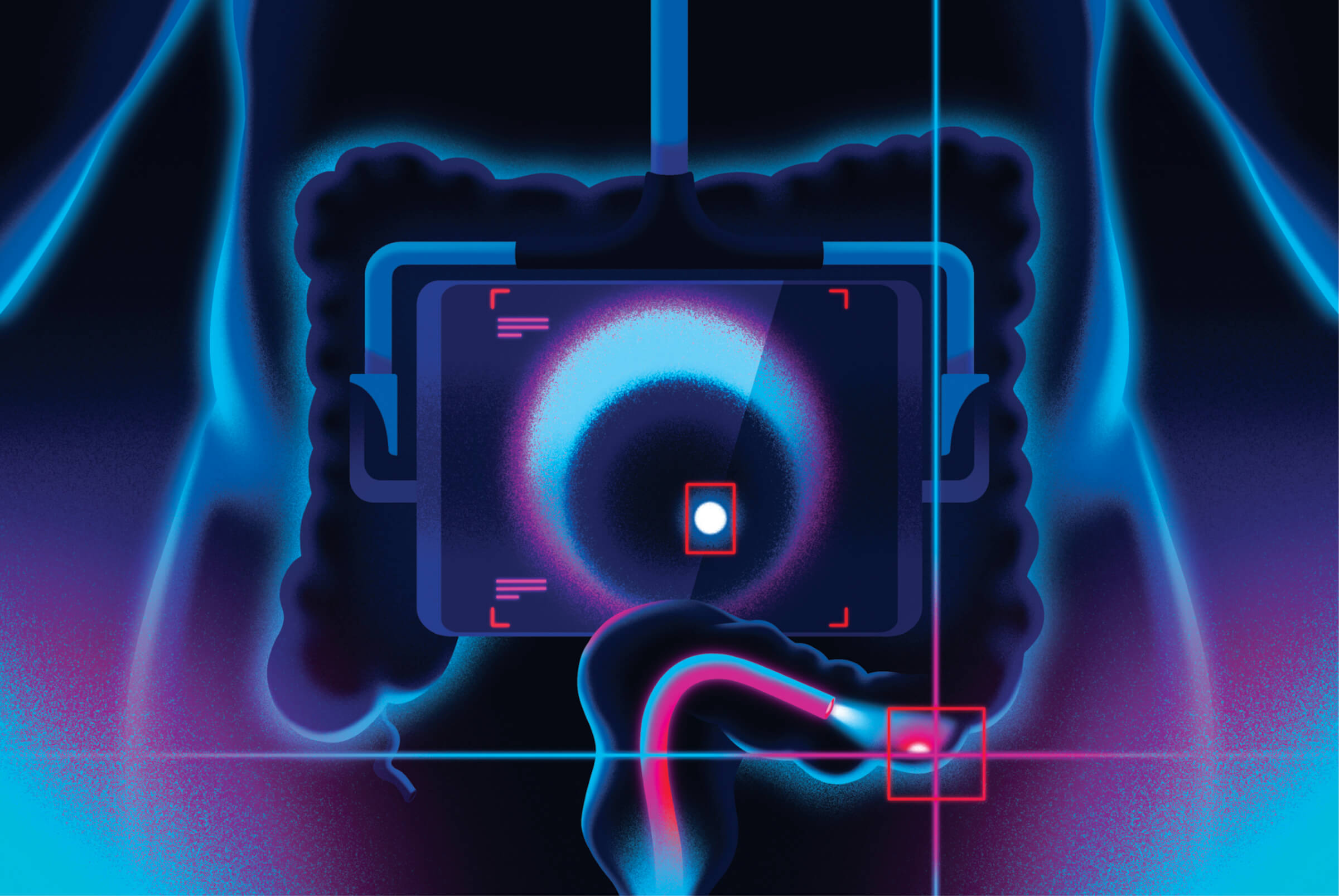 Illustration of technology screening for colon cancer