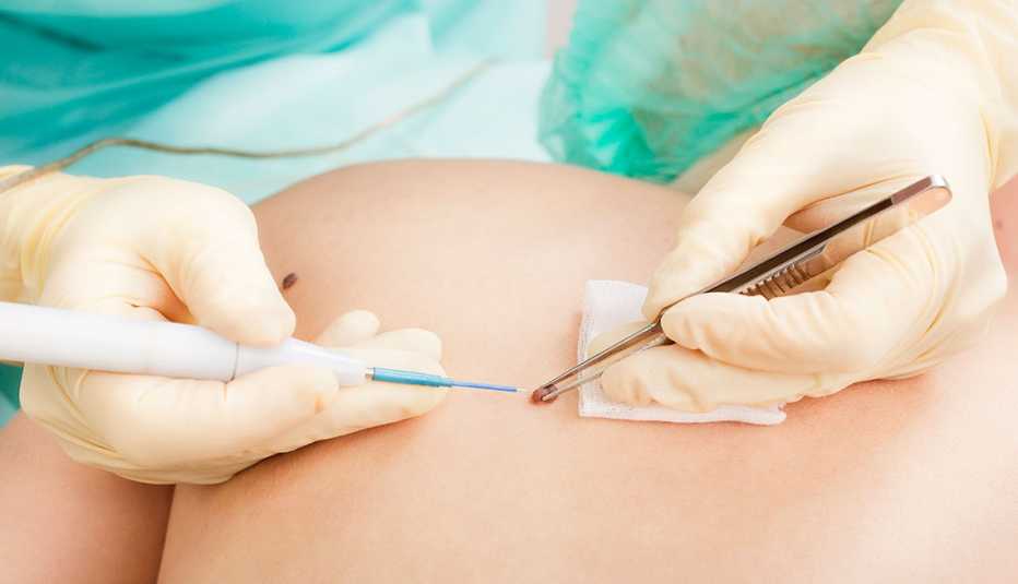 a doctor removing a skin tag on patient's back