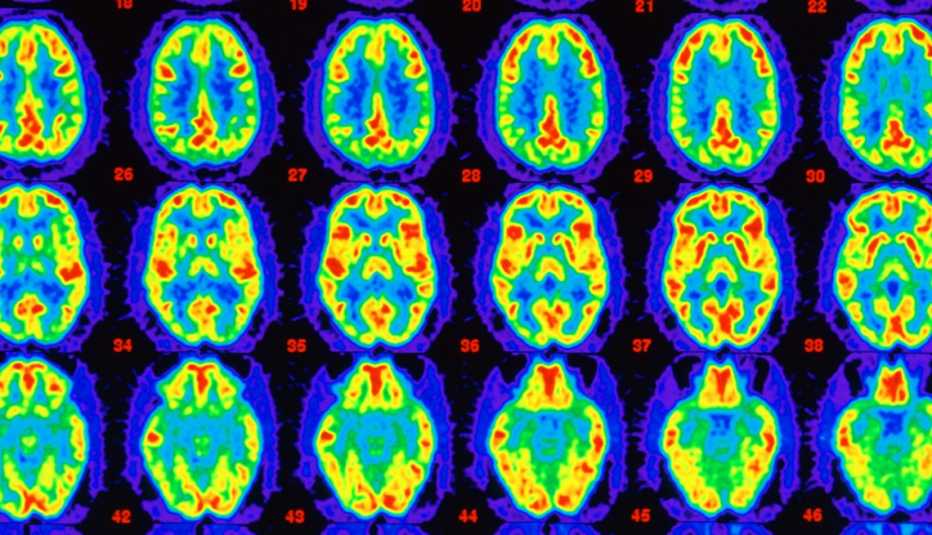 PET Brain Scans