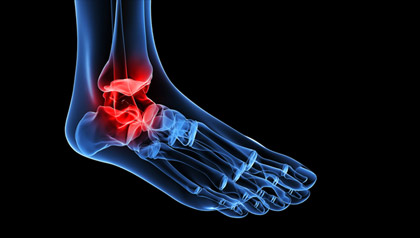 A new CDC study finds surprising differences among Hispanic subgroups when it comes to arthritis. 
