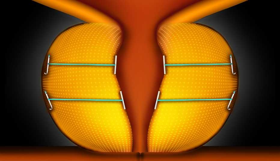 UroLift Procedure Could Help Men with Enlarged Prostates UroLift Procedure Could Help Men with Enlarged Prostates