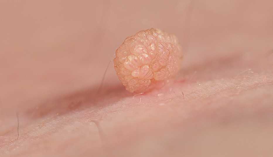 close up of a skin tag or acrochondon close up of a skin tag or acrochondon