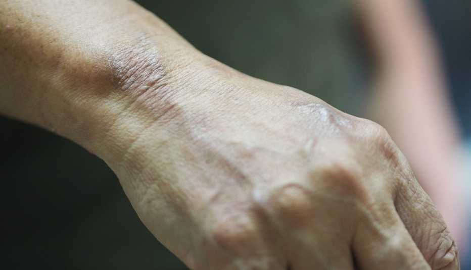 blister on the back of a woman's hand