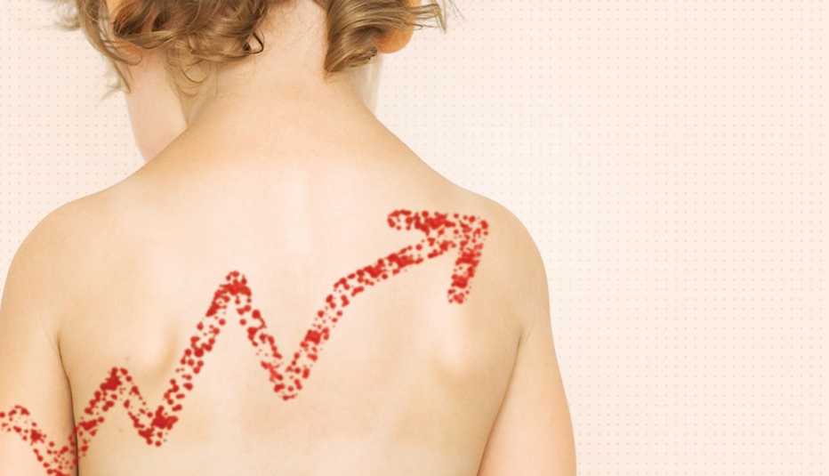 Measles cases are on the upswing Little girls bare back overlaid with a line graph made of a measles rash cases of the measles are on the rise