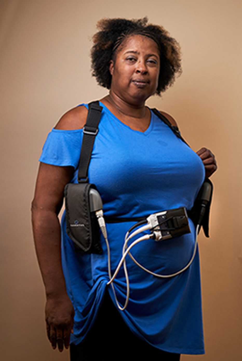 Brenda Smith with her heart pump Brenda Smith with her heart pump