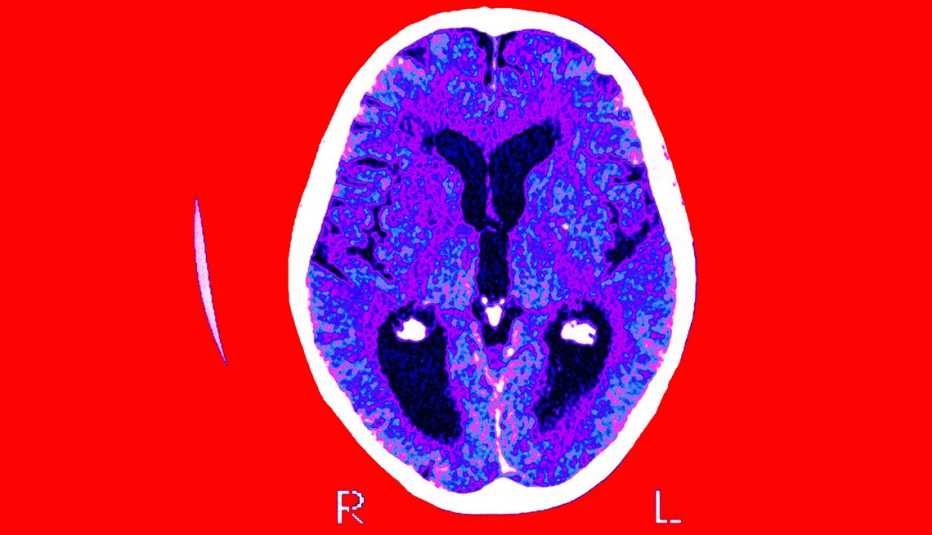 Scan of a brain that has Alzheimers disease scan of a brain that is showing signs of alzheimers disease