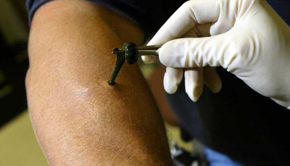 Escalofríantes avances científicos: sanguijuelas para limpiar la sangre