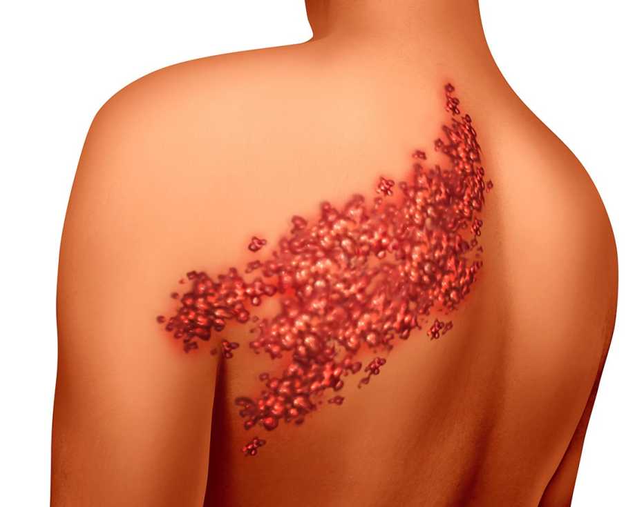 shingles disease viral infection concept graphic