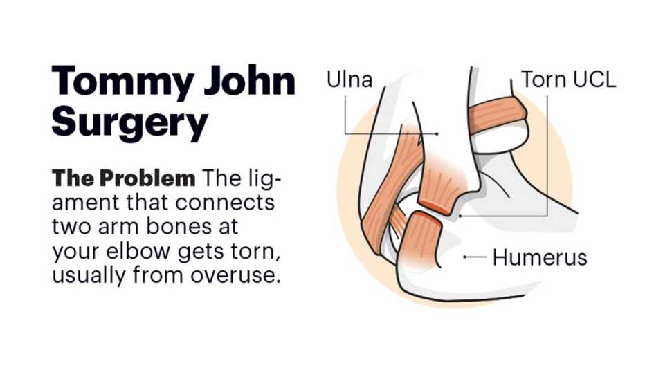 An elbow before Tommy John surgery An elbow before Tommy John surgery