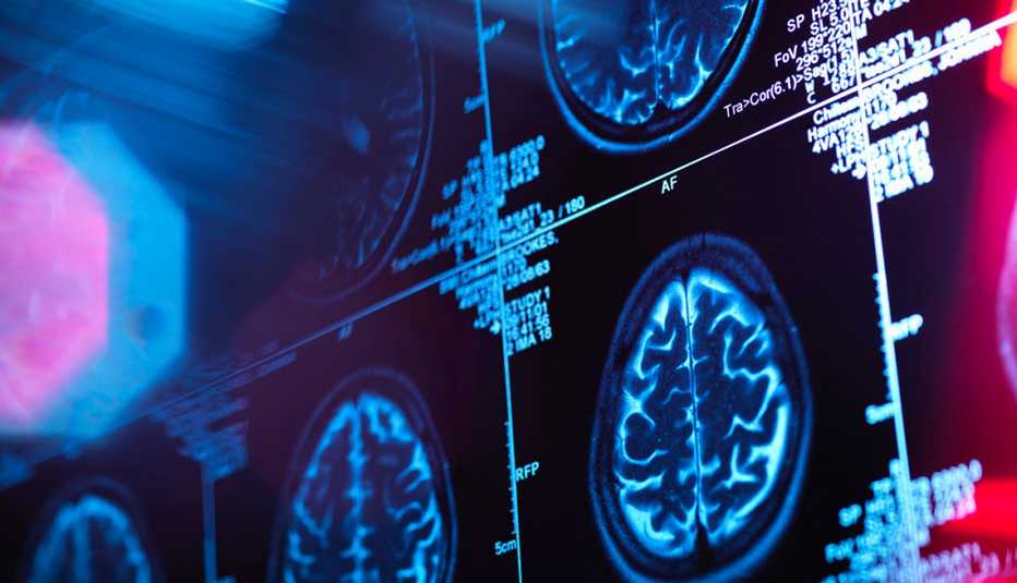 brain scan image