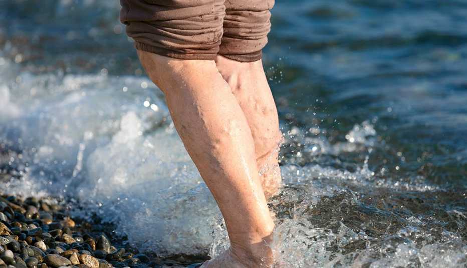 legs of a woman with varicose veins in the ocean