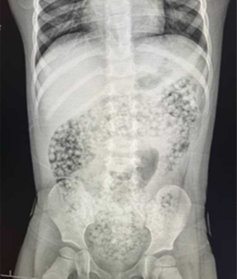X-ray showing water bead toys that were ingested in a child’s intestines. ex ray showing a childs torso where you can see water bead toys that were ingested throughout the intestines