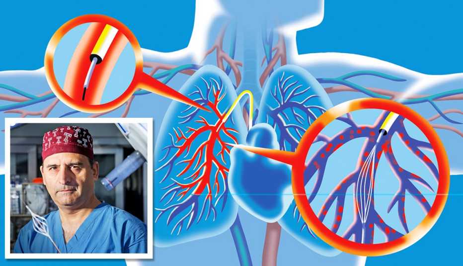 rendering of a catheter that unclogs arteries and inset photo of doctor riyaz bashie who invented the device