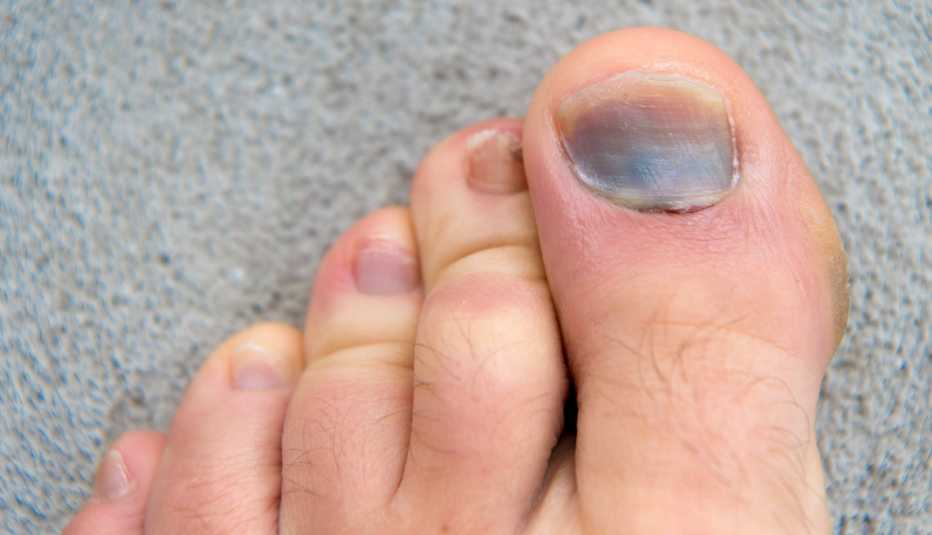 Feet with darkened toenails