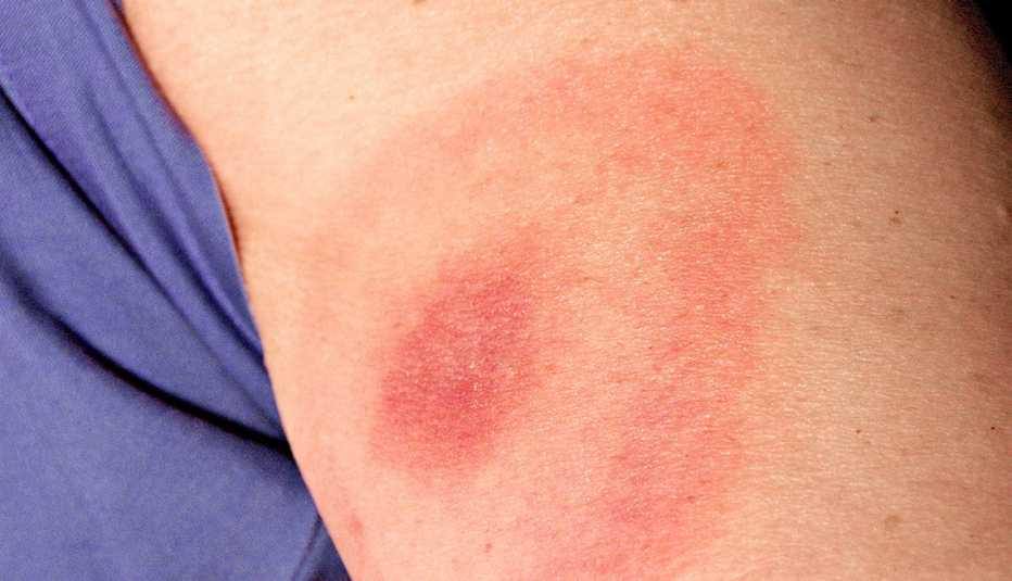 tick bite bullseye