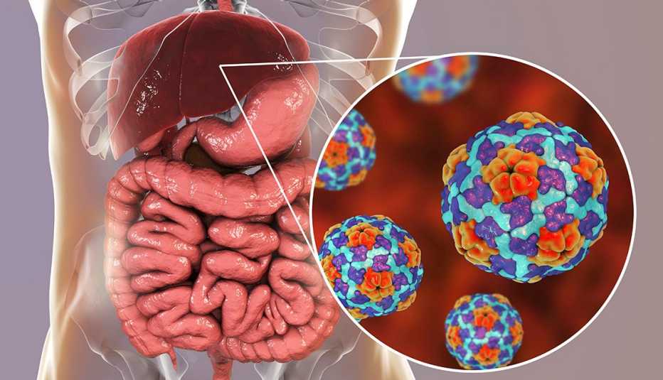 Illustration of a Hepatitis A infection. 