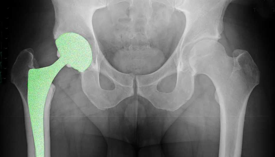x ray of a hip