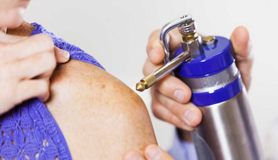 Dermatólogo realizando crioterapia con nitrógeno líquido.