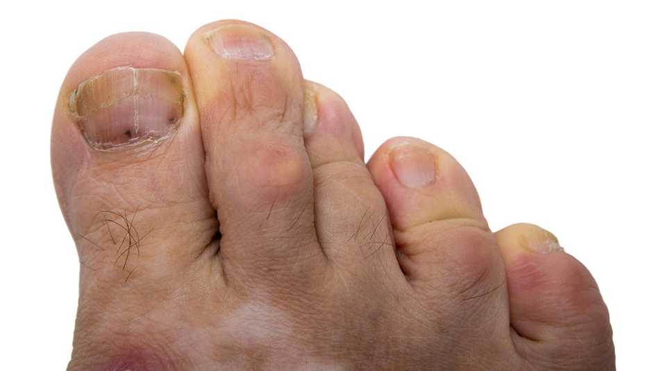 Uñas del pie con cáncer Uñas del pie con cáncer