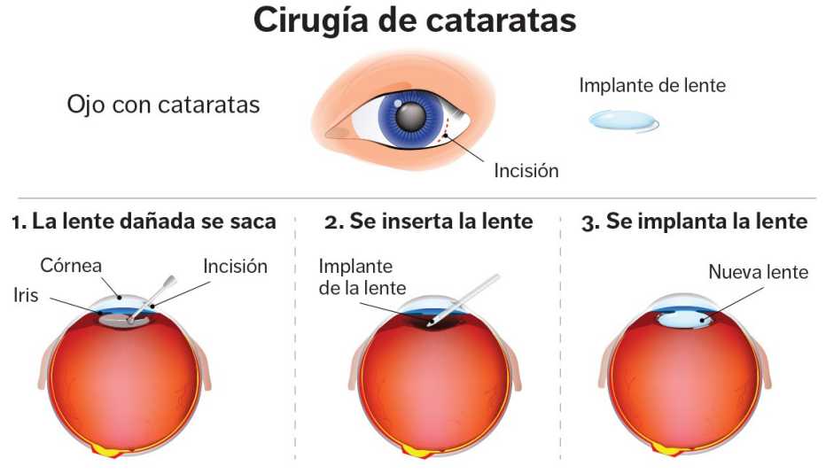 Gráfico del proceso de una cirugía de cataratas Gráfico del proceso de una cirugía de cataratas