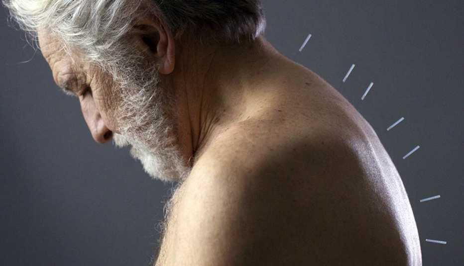 Hombre con agujas de acupuntura