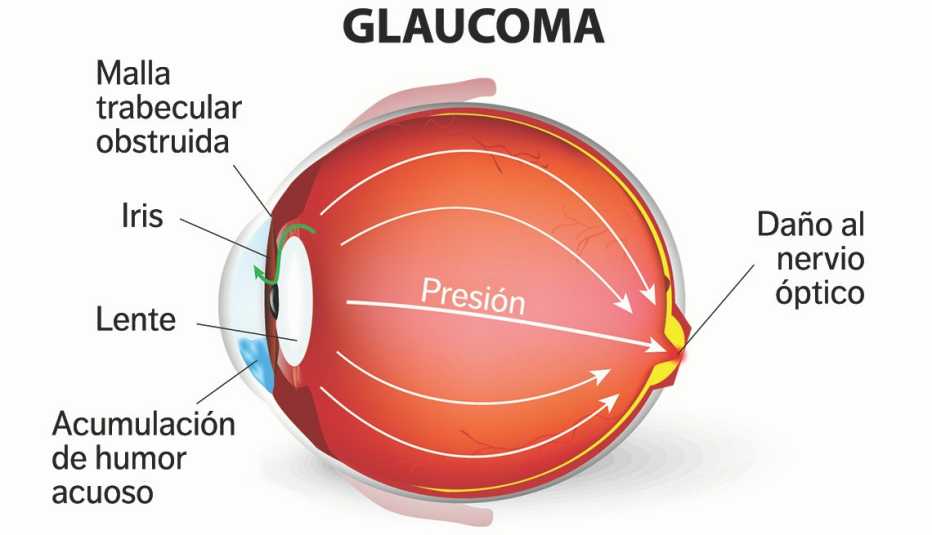 Ilustración de un ojo que padece de glaucoma