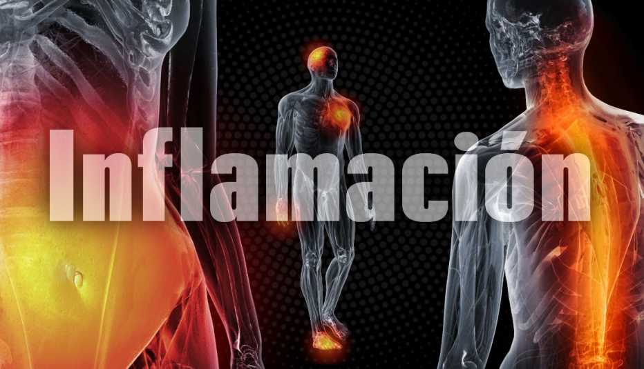 Ilustración sobre la inflamación en el cuerpo
