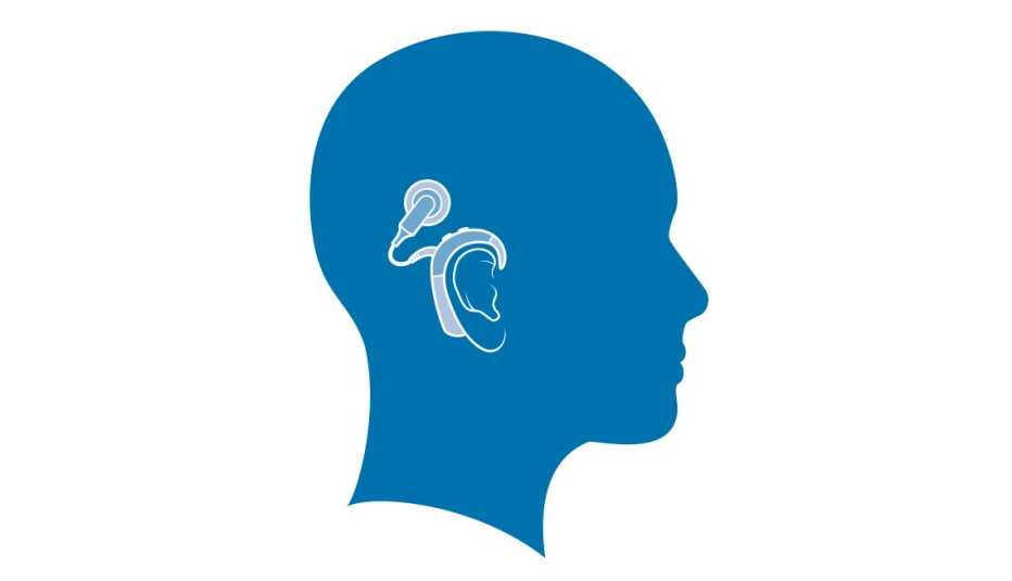 Ilustración de una persona con un implante coclear