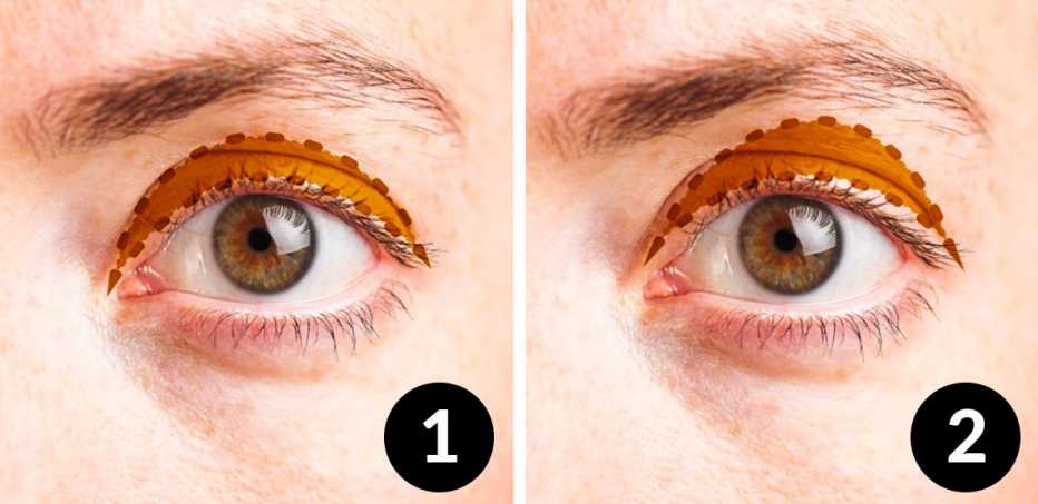 Blefaroplastia del párpado superior