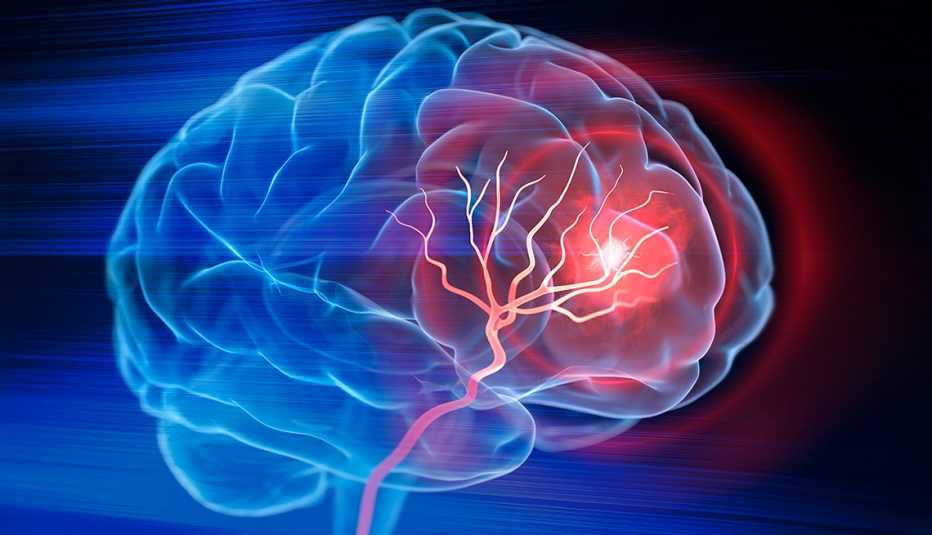 Ilustración de un cerebro humano que sufre un derrame cerebral Ilustración de un cerebro humano que sufre un derrame cerebral