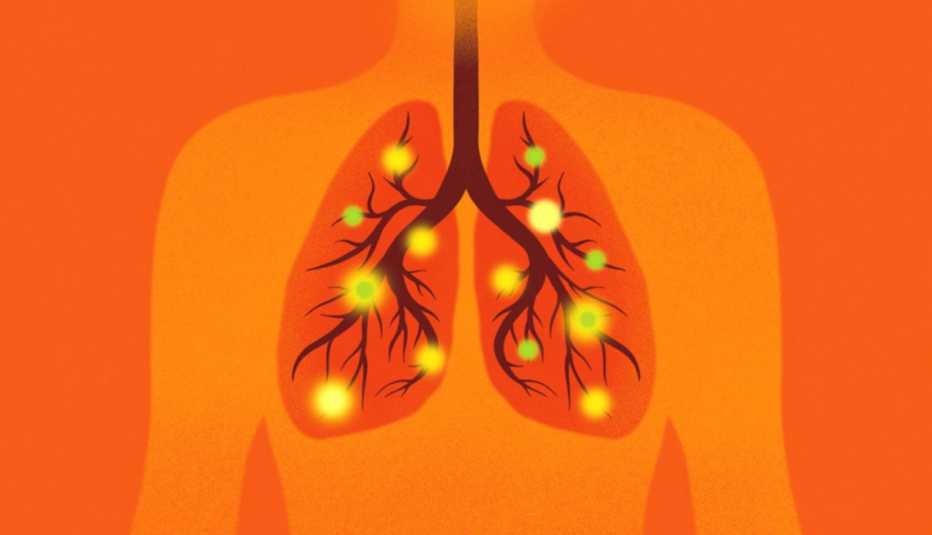 Ilustración del tórax de una persona con los pulmones llenos de bacterias Ilustración del tórax de una persona con los pulmones llenos de bacterias