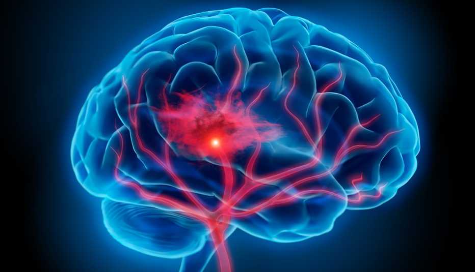 Ilustración de un cerebro humano sufriendo un derrame