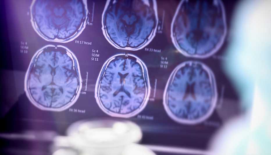 Imagen de un cerebro con Alzheimer