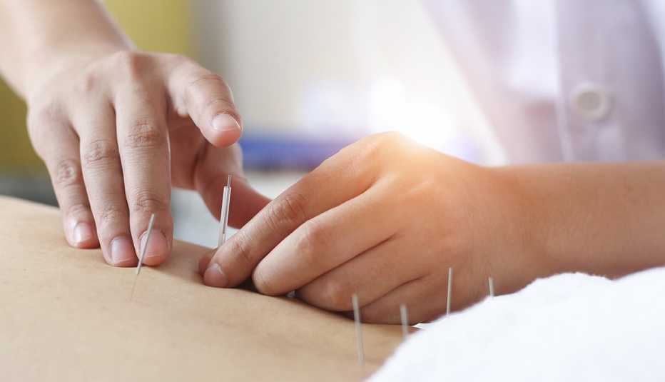 Paciente en una sesión de acupuntura