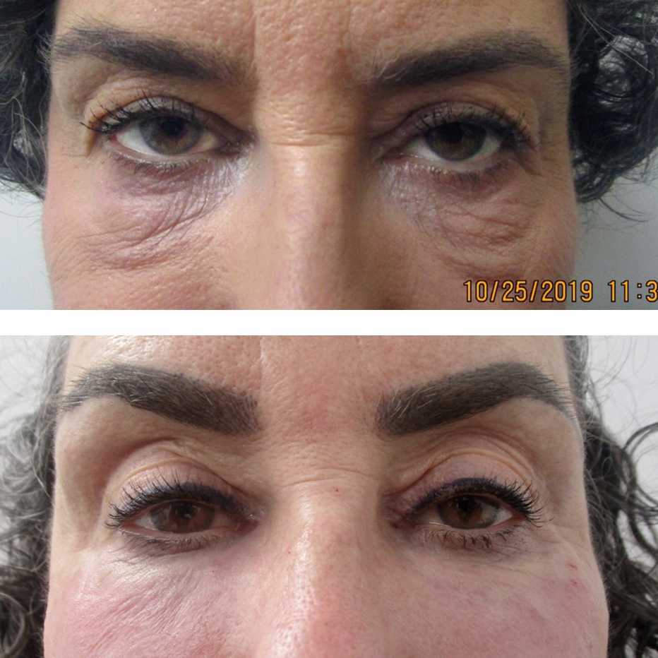 Foto superior: los bultos debajo de los ojos de esta paciente se deben a un relleno mal colocado. Foto inferior: se corrigió el problema disolviendo el relleno, moviéndolo a lugares correctos y luego tensando la piel con un láser.